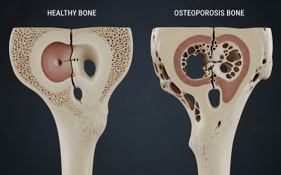 Blog 6 Understanding Bone Density Changes and How to Strengthen Your Framework